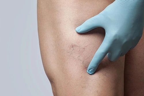 Superficial Veins Removal with IPL