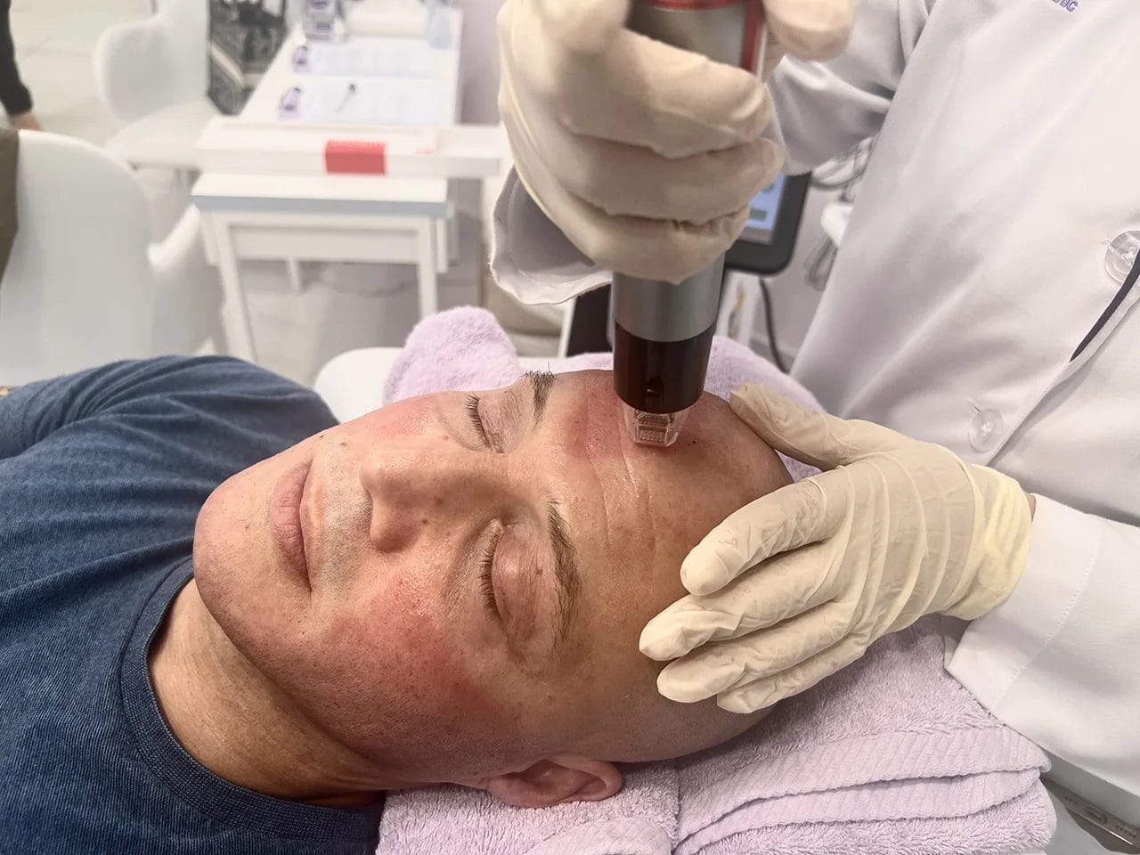 RF Micro needling Dubai