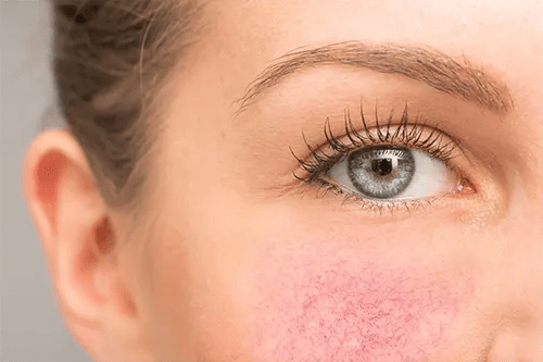 Rosacea Removal with IPL