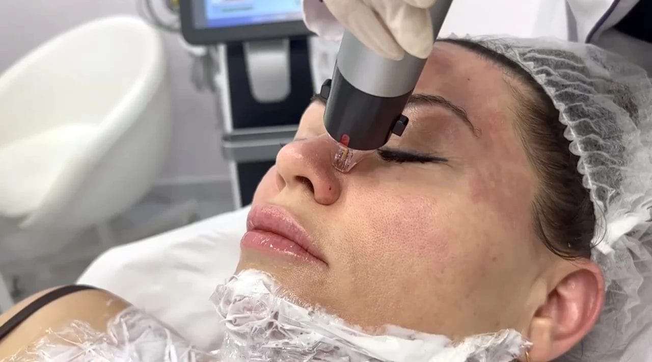 RF Micro needling Dubai