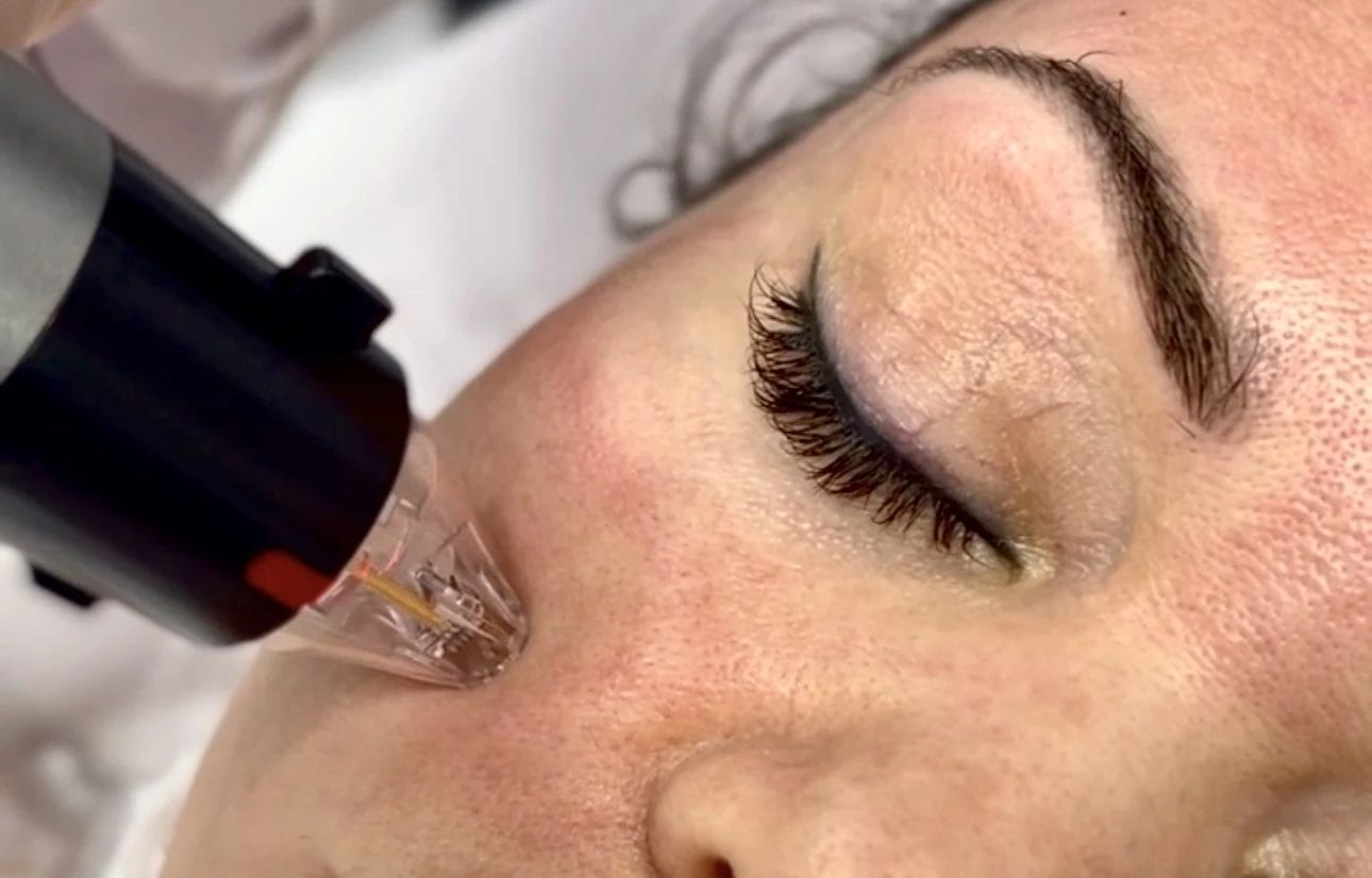 RF Microneedling for Acne Scars