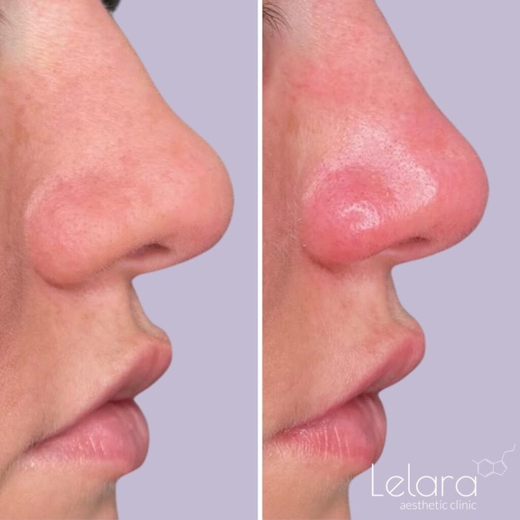 Best Nose Botox in Dubai at Lelara Clinic