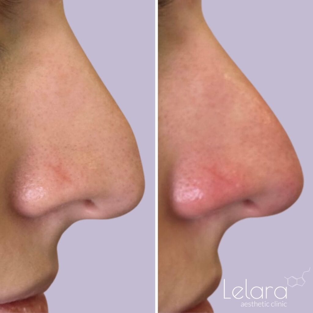 Non Surgical Nose Job with Botox 