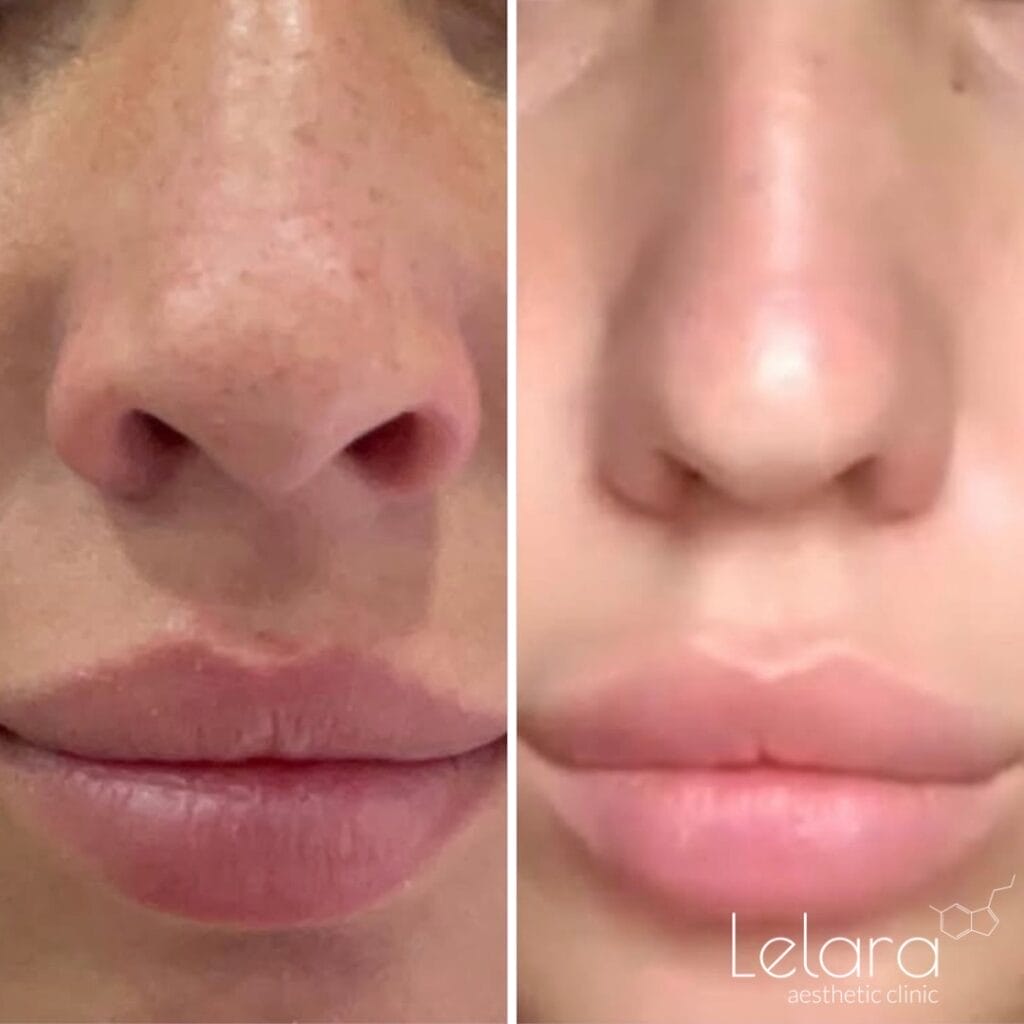 Nose Slimming Botox Before & After