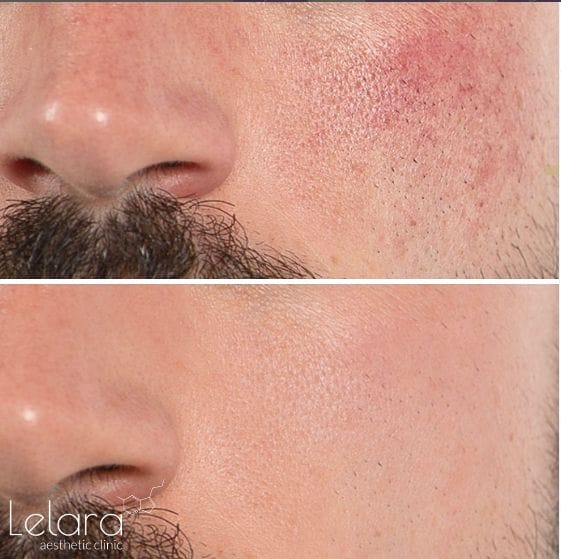 pigmentation-treatment Fascinating Results
