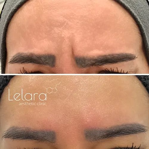 Forehead Botox before after results