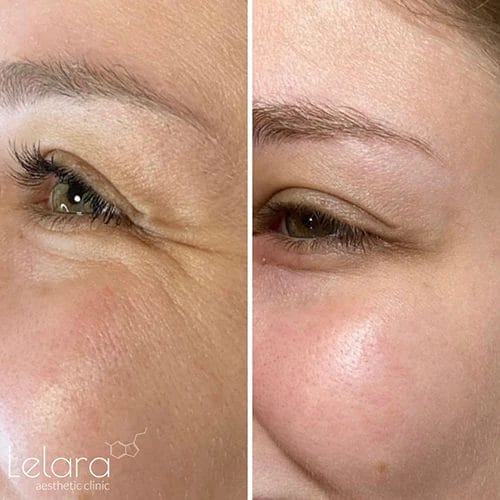 Botox for patient before and after