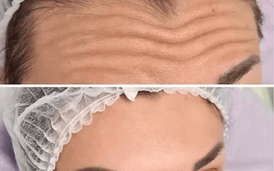botox before and after Patient Results