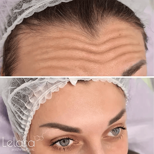 Botox treatment in Dubai before and after