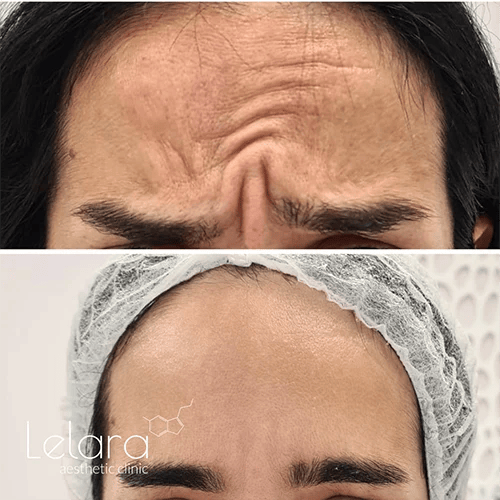 Botox treatment for asymmetric face