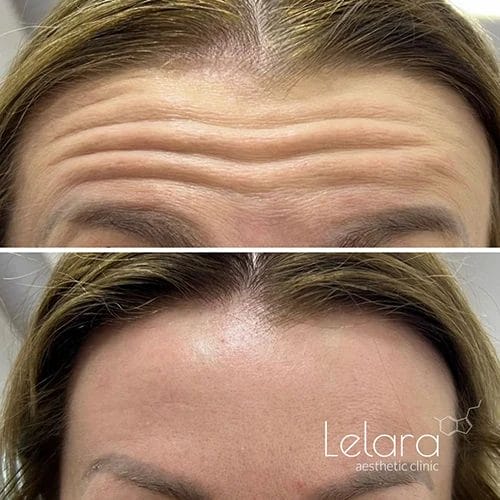 Botox for frown lines before and after