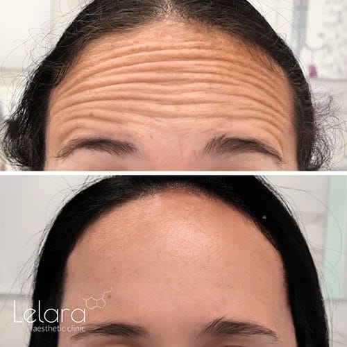 Wrinkles Botox before and after