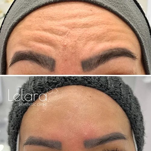 Frown lines Botox before after image
