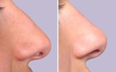 Nose Botox vs. Nose Fillers: Which is Right for You?