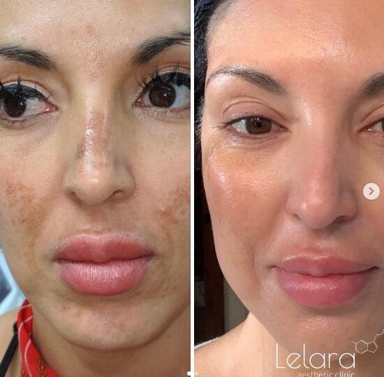Hyperpigmentation-Removal-IPL IPL for Pigmentation & Hyperpigmentation Removal