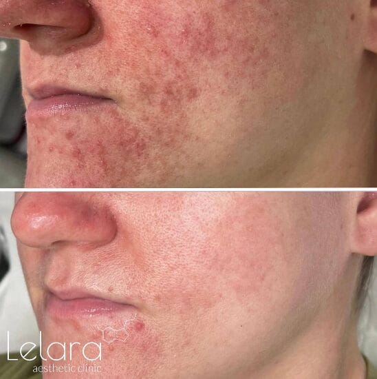 IPL-Acne Fascinating Results