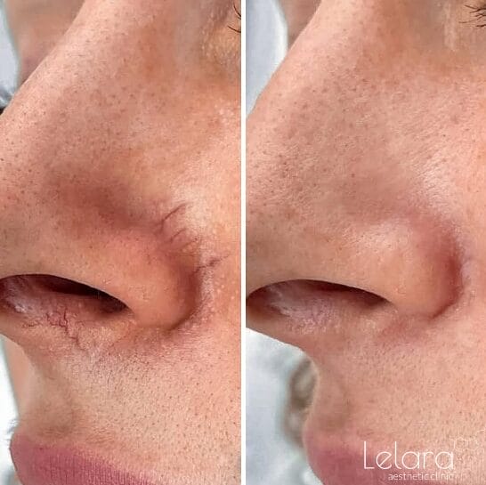 Pigmentation-Treatment Fascinating Results