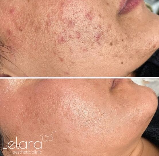 RFMicroneedling-for-Acne