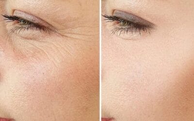 Botox for Undereyes