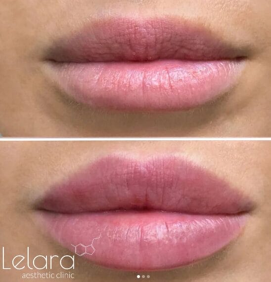 Lip Fillers in Dubai