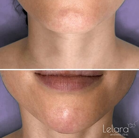 Chin Fillers at Lelara Clinic