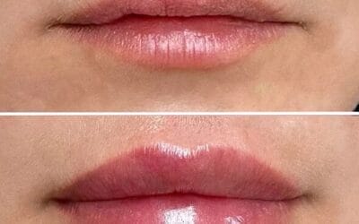 Russian Lip Fillers