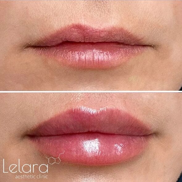 Lip Fillers at Lelara Clinic