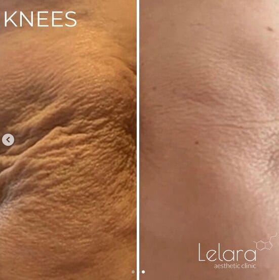 Skin Rejuvenation Before & After with Icoone Laser 