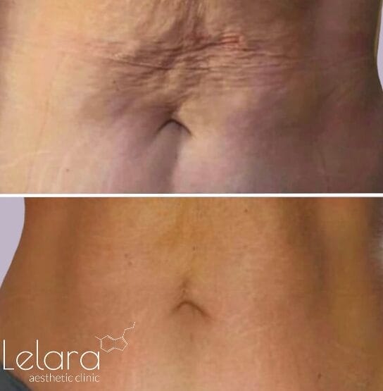 Cellulite Reduction with Icoone Laser Dubai