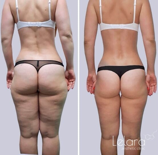 Body Shaping with Icoone Laser Dubai