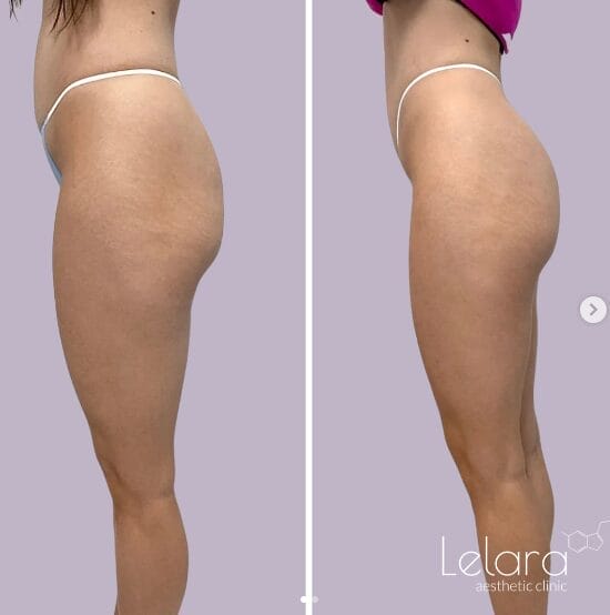 Body Shaping Before & After with Icoone Laser 