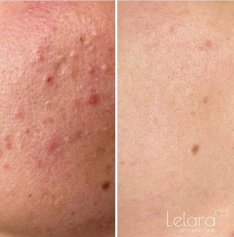 Acneprone-facial-treatment