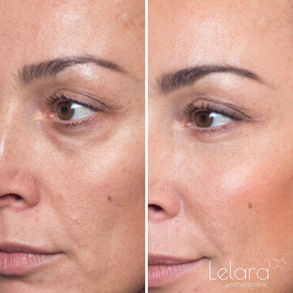 dermal fillers for under eyes in Dubai