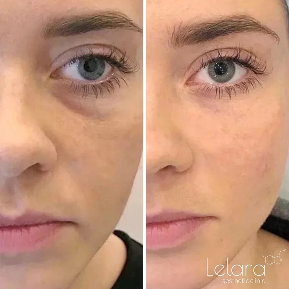 Undereye Fillers