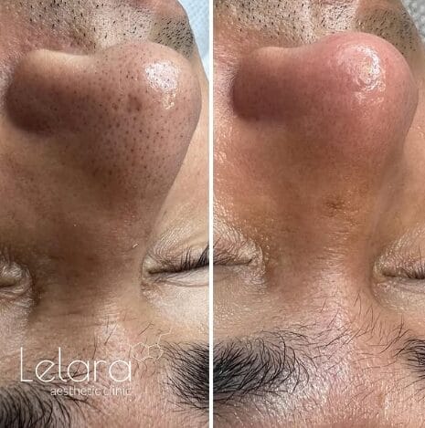 Before & After Facial Treatment for Men at Lelara Aesthetic Clinic Dubai