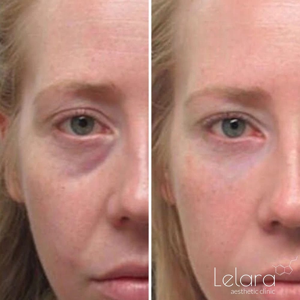 fillers for under eyes in Dubai