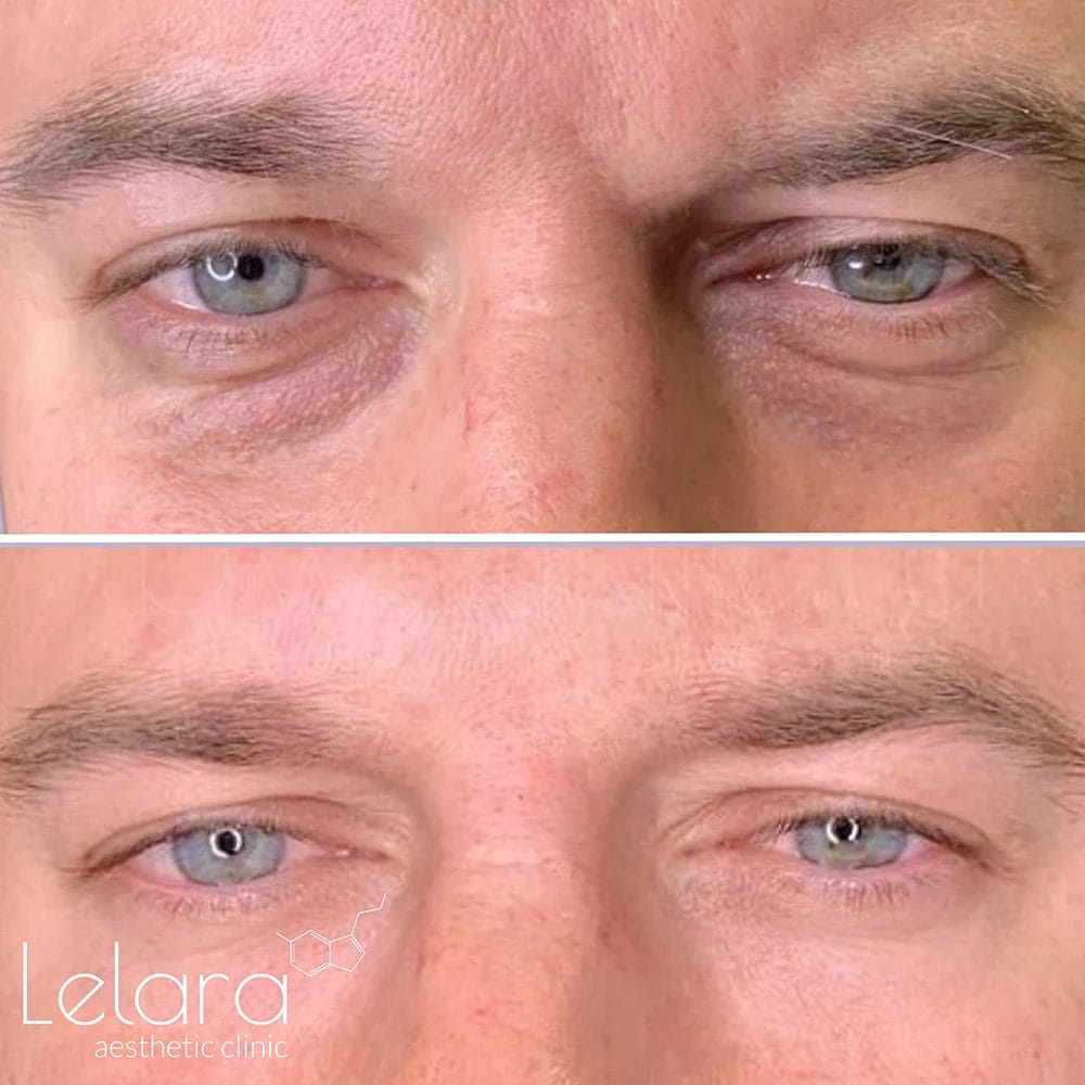 undereye fillers for men in dubai