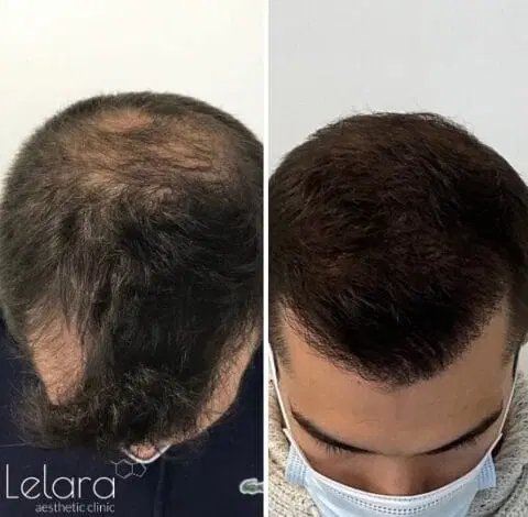 Hair Loss Treatment Dubai