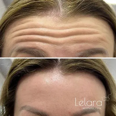 Injectables