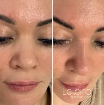 Nose Slimming Dubai